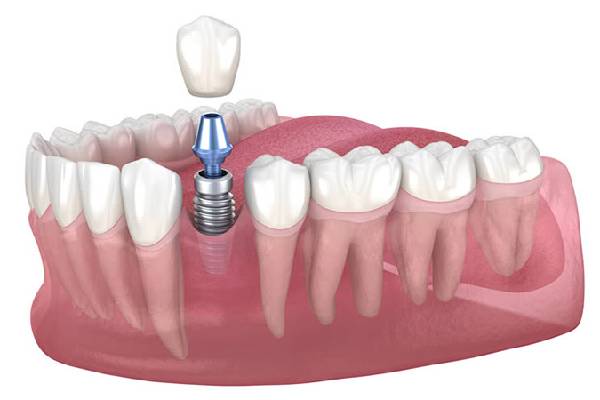 Dental Implant